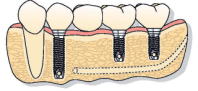 インプラント治療の図